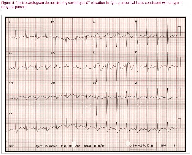 הדברים השכיחים ביותר שאלקטרוקרדיוגרמה יכולה לזהות אצל ספורטאים