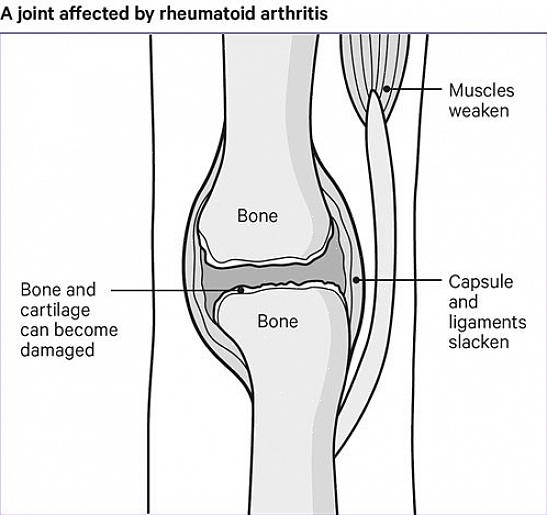 הנקודה הראשונה שיש לזכור כדי לטפל במפרקים שלך היא לעשות מספיק פעילות גופנית